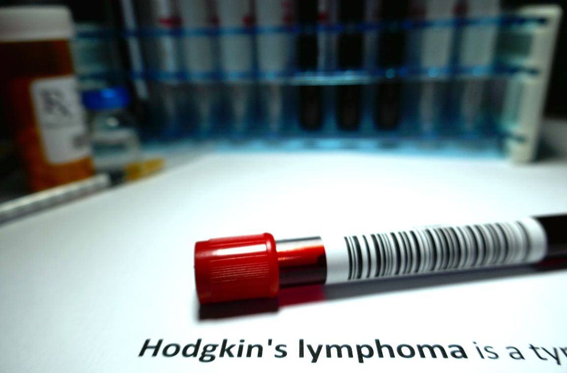 hodgkin's lymphoma blood sample