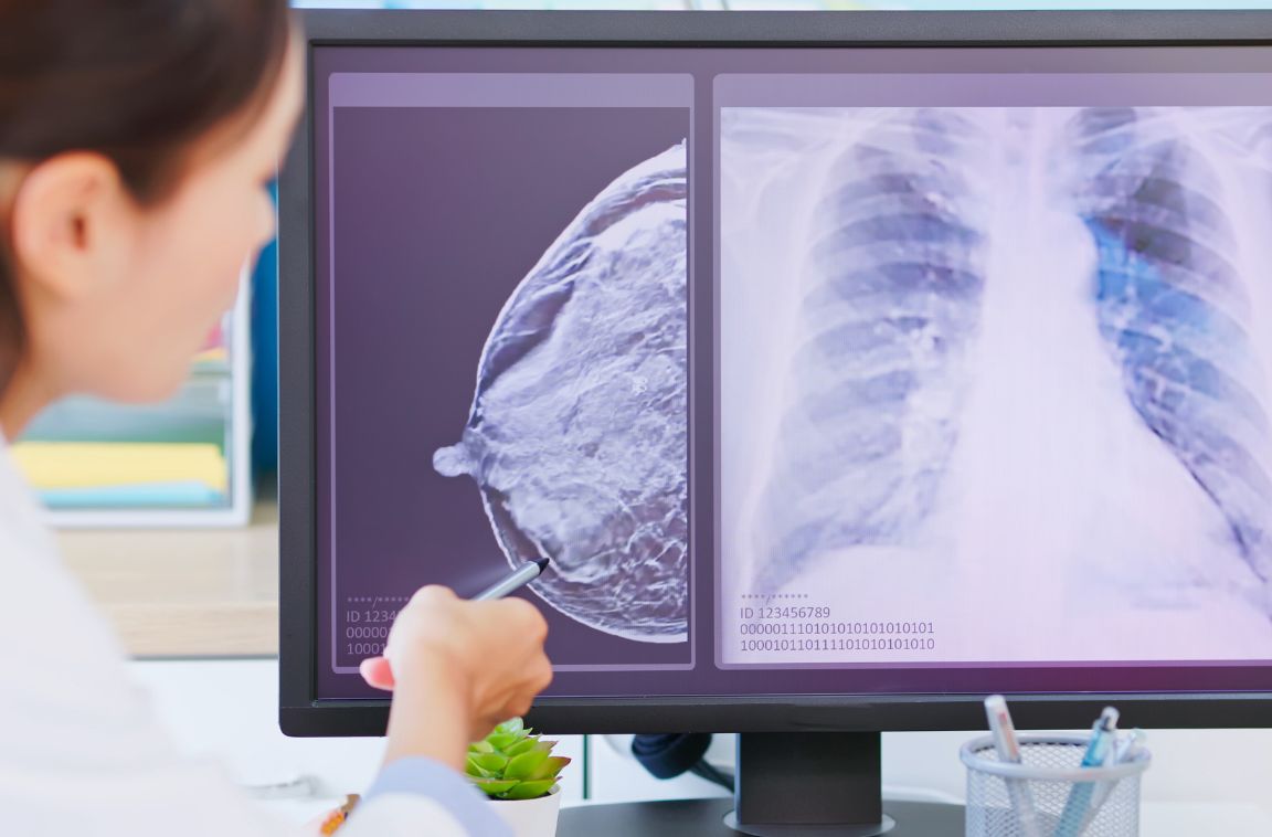 a breast cancer screening